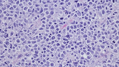 Lymphoma cells