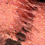 PANCREATIC CANCER 200x200