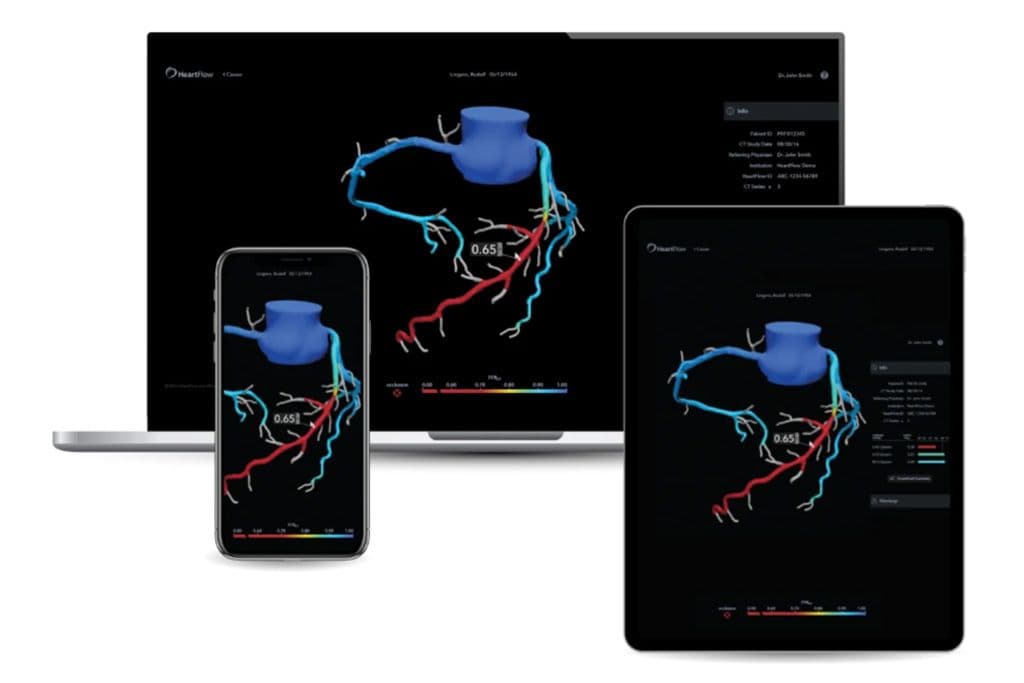 Three images of a heart scan on laptop, tablet, and mobile phone screens