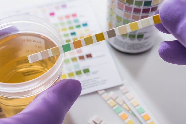 Urine sample with colour coded UTI test chart in the foreground