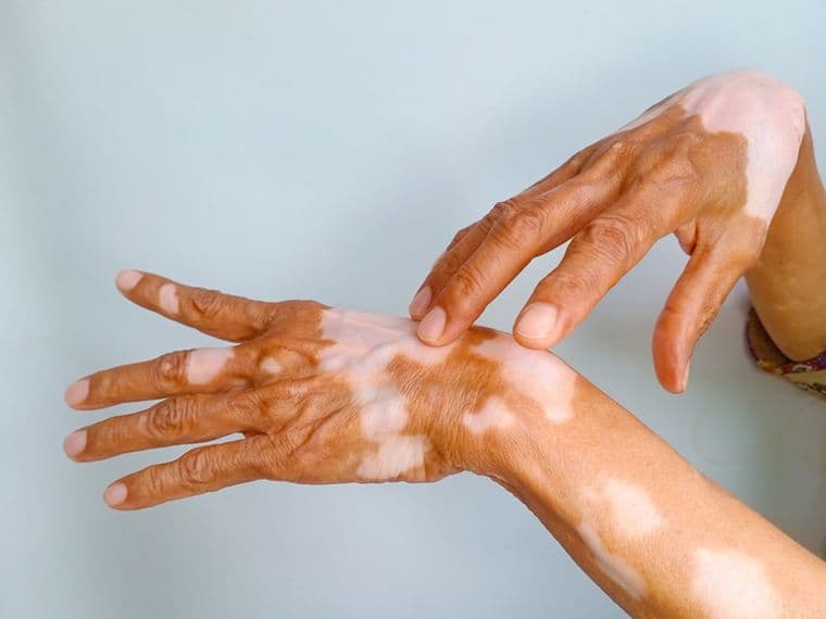 Hands with vitiligo showing patches of depigmented skin against a light background.